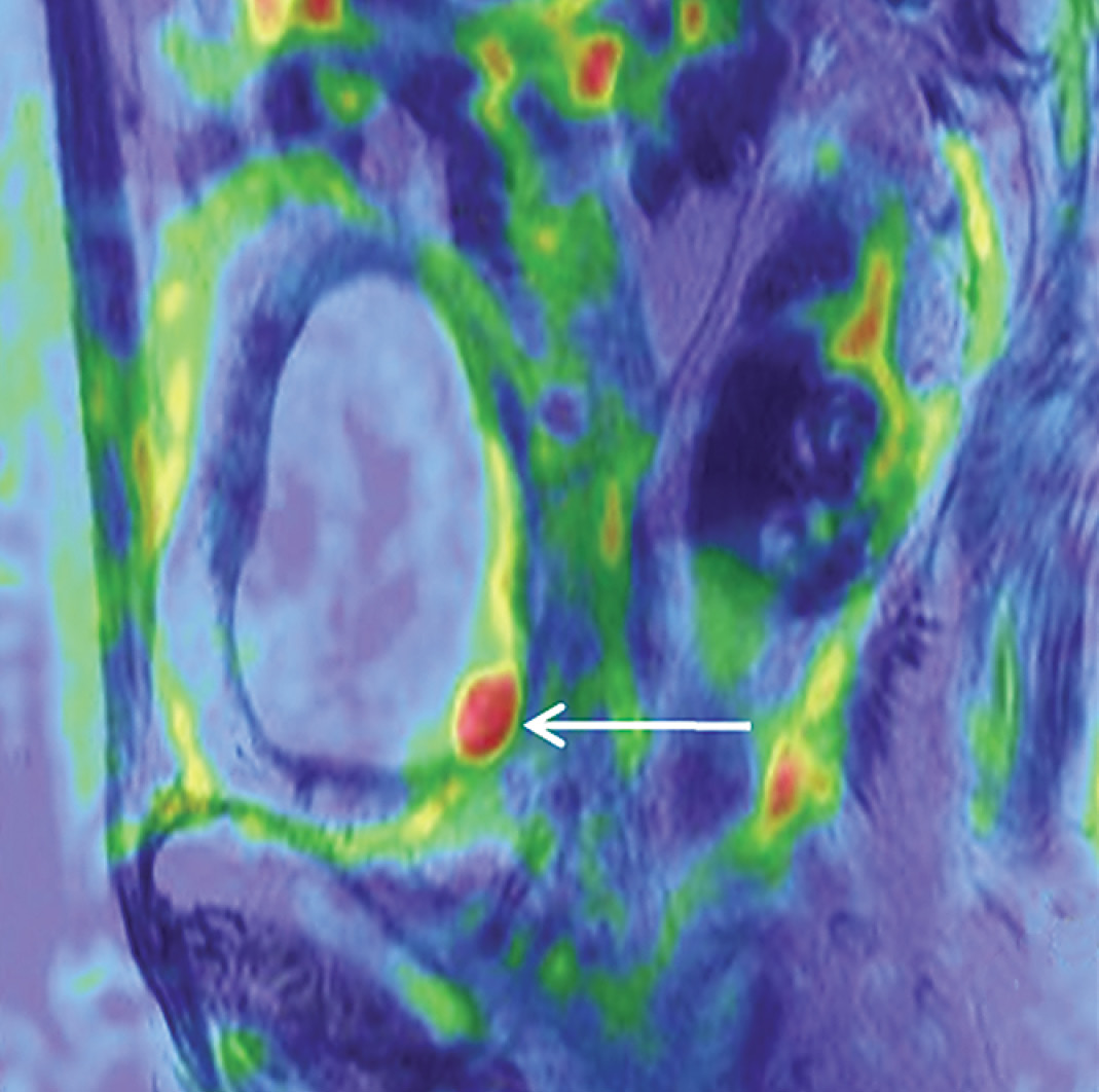 Tumor recurrence in cervical cancer patient